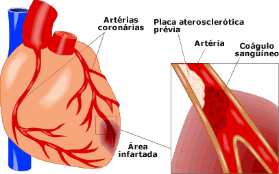 Sintomas do infarto agudo do miocárdio